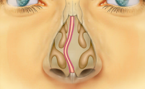 Deviated Septum Treatment