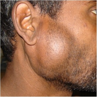 Parotid Swelling Treatment